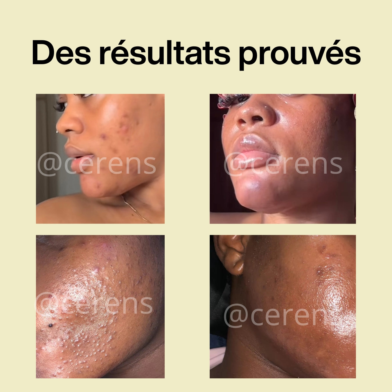 Savon Purifiant à l’Huile d’Arbre à Thé – CERENS-LOT de 2